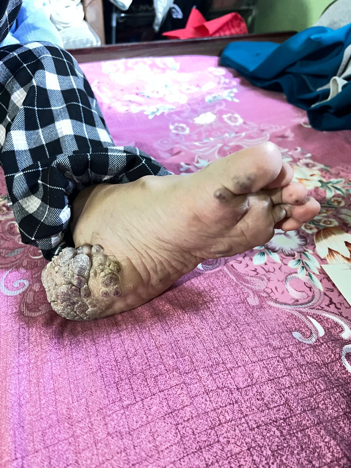Financial support for Disability shoes